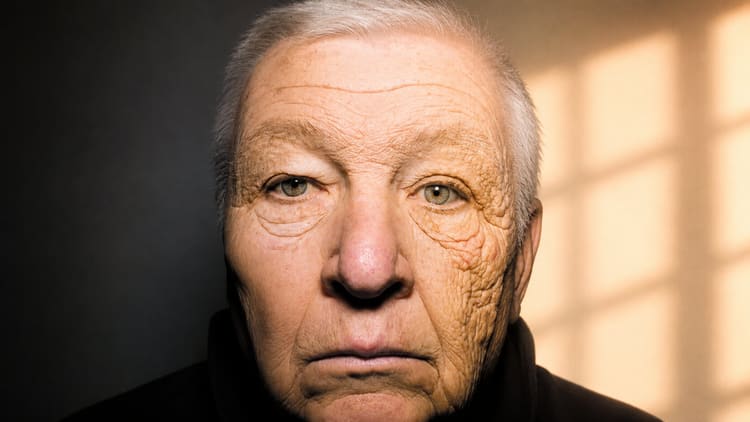 One-sided photoaging on the face of a long-time delivery driver